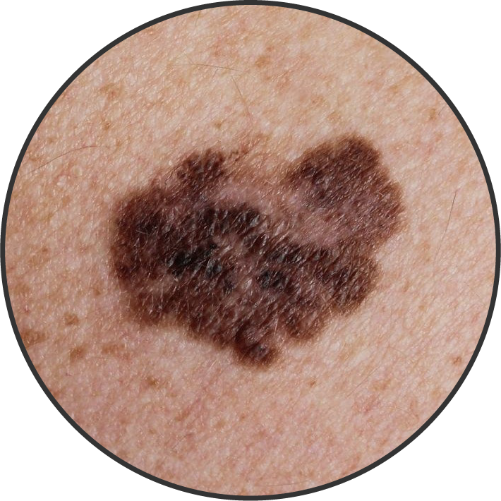 Imagem ilustrativa do melanoma